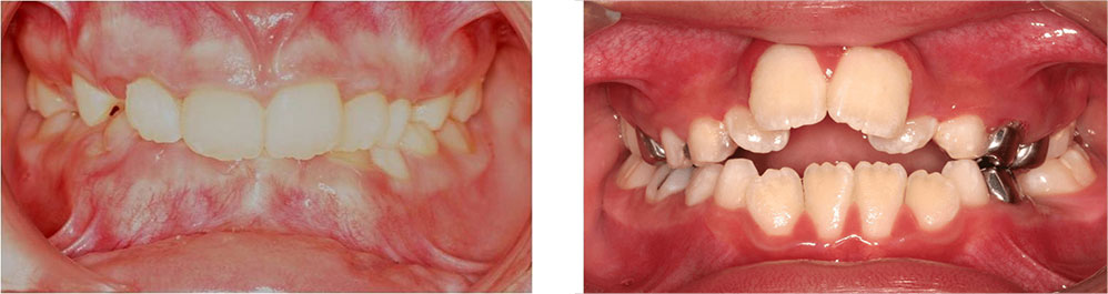 Brace Treatments