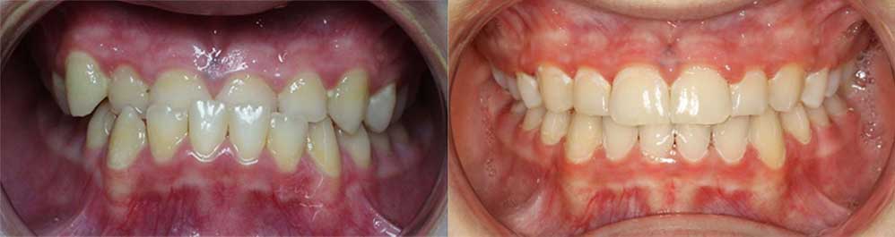 Dental Tooth straightening treatment 