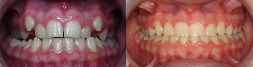 Teeth straightening