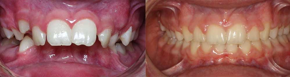 Tooth straightening