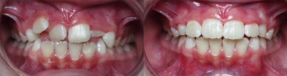 interceptive orthodontics