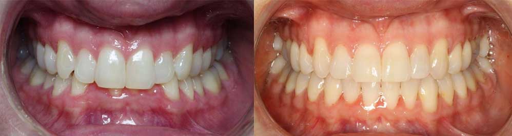 Teeth straightening